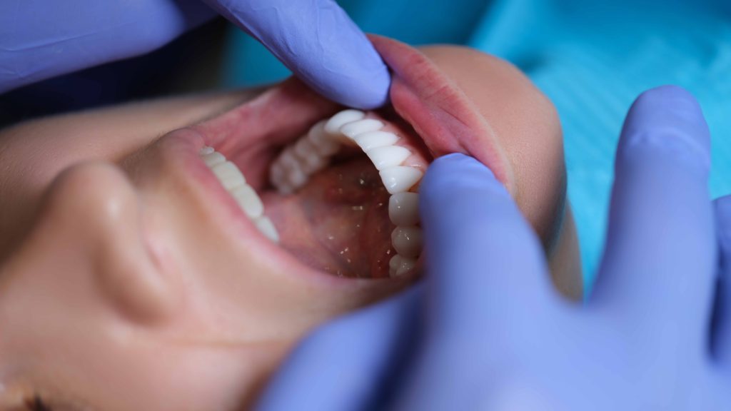 下の前歯の治療